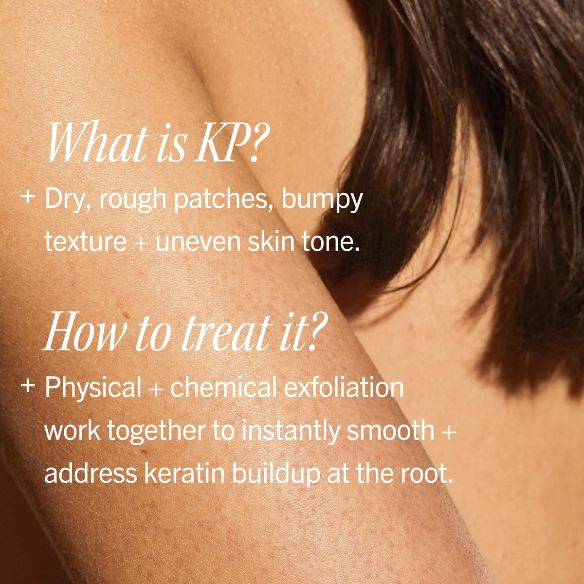 First Aid Beauty KP Bump Eraser Body Scrub Fresh Strawberry Scent, 10% AHA Keratosis Pilaris Exfoliator - Glycolic & Lactic Acid with Pumice, Treatment for Strawberry Legs, Razor Bumps & Rough Bumpy Skin, 8 oz 🍁 All In One Marketplace Canada